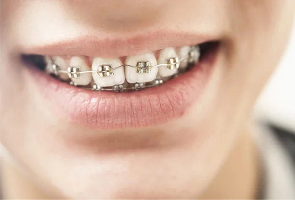 Braces