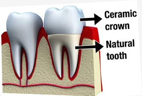 Ceramic Crowns