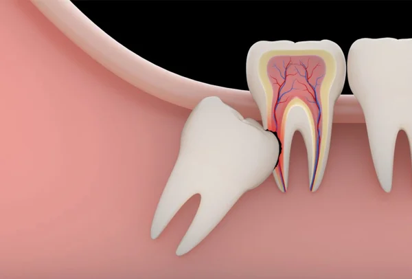 Extraction, Impaction